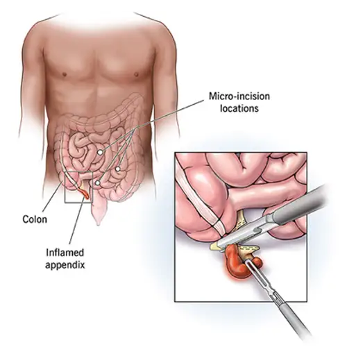Appendix Removal Surgery in Anand