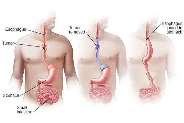 Esophageal Surgery for Cancer in Surat