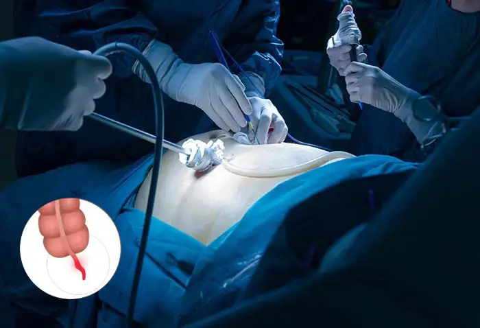 laparoscopic appendectomy surgery