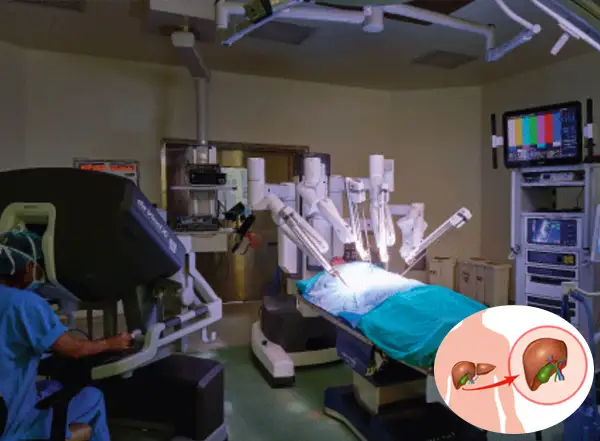 Robotic Liver Transplant Surgery in Surat