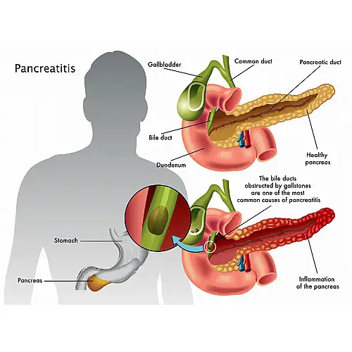 Pancreatic Surgeon in Surat