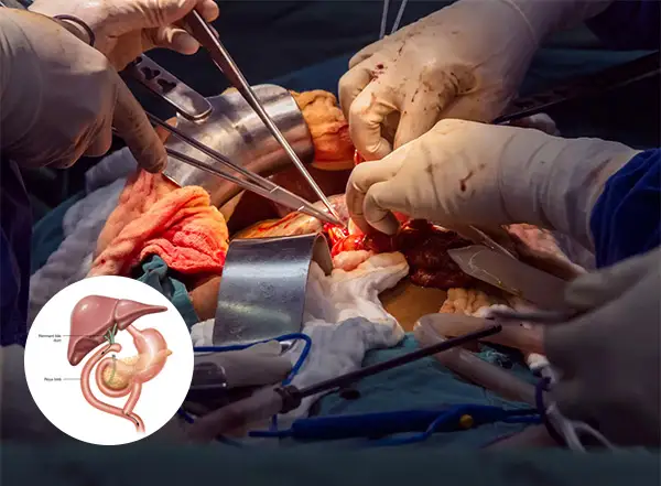 urgical Biliary Bypass Surgery
